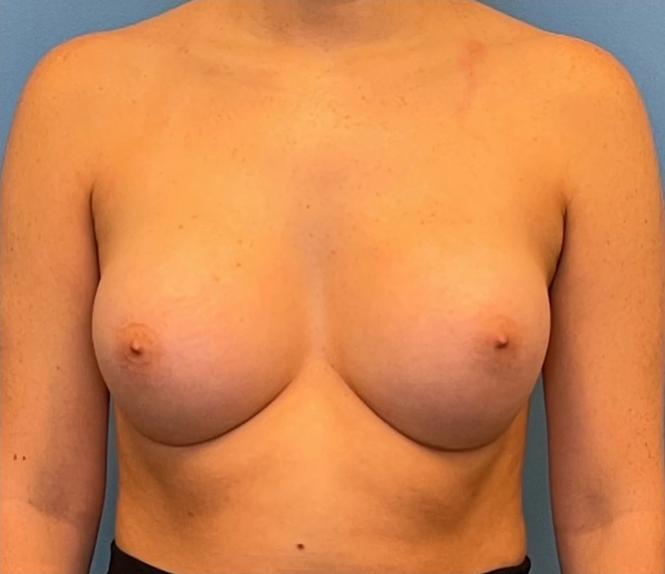 Breast-Augmentation-Case--224 | After Breast 1