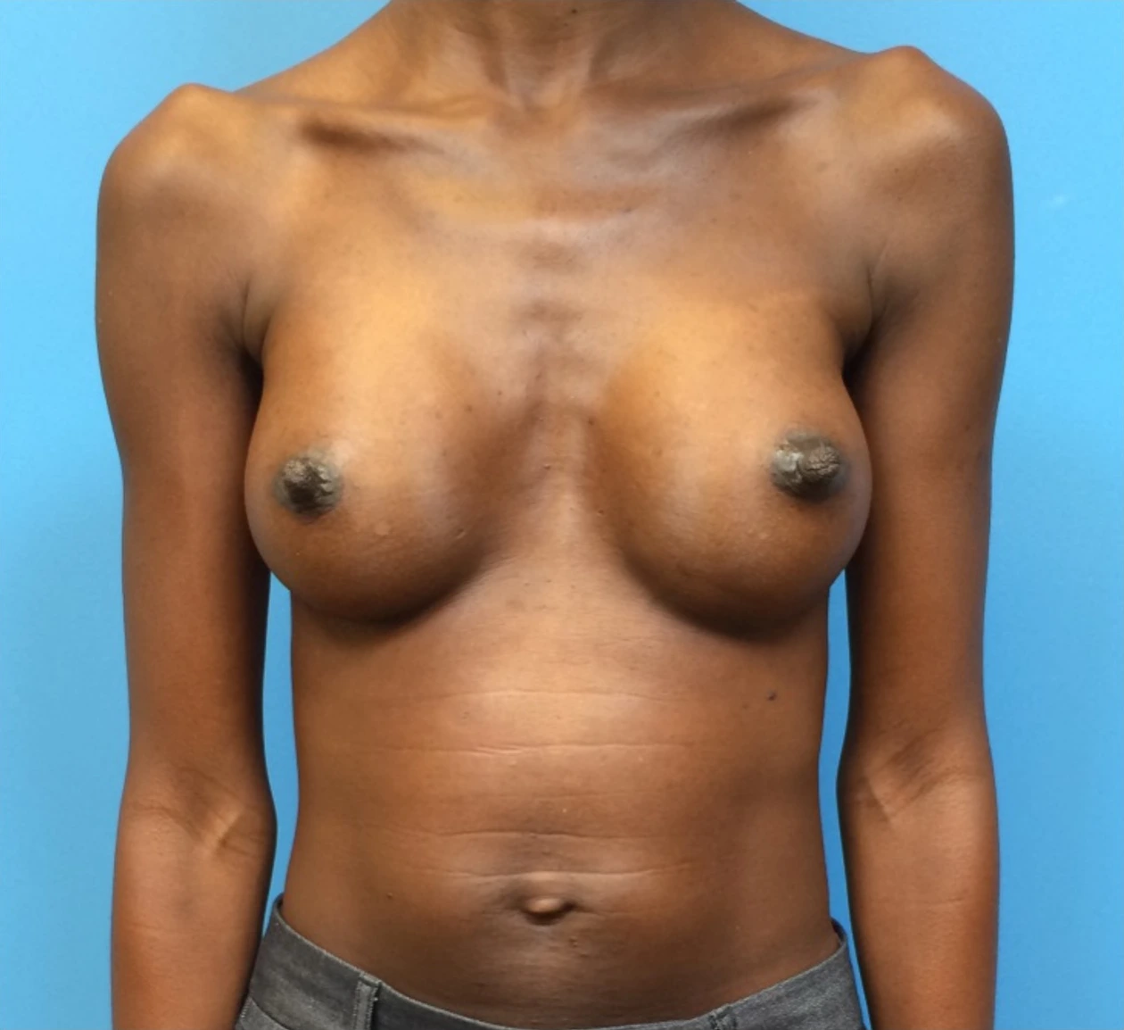 Case--97 | After Breast 1
