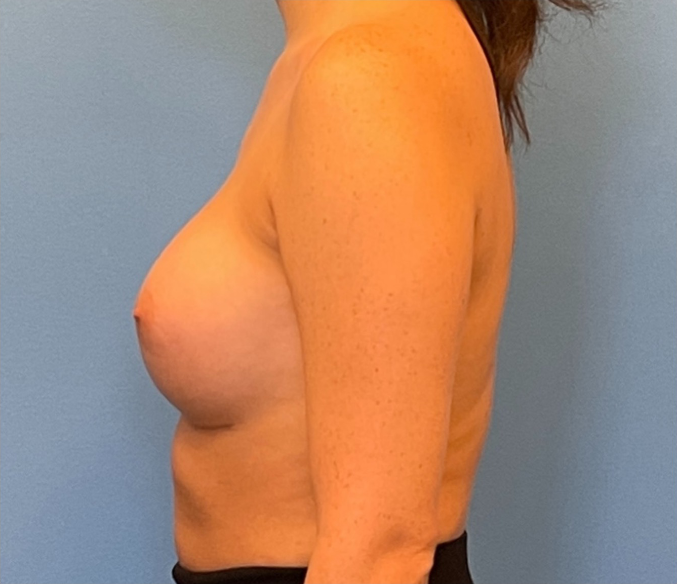 Breast-Augmentation-Case--224 | After Breast 2
