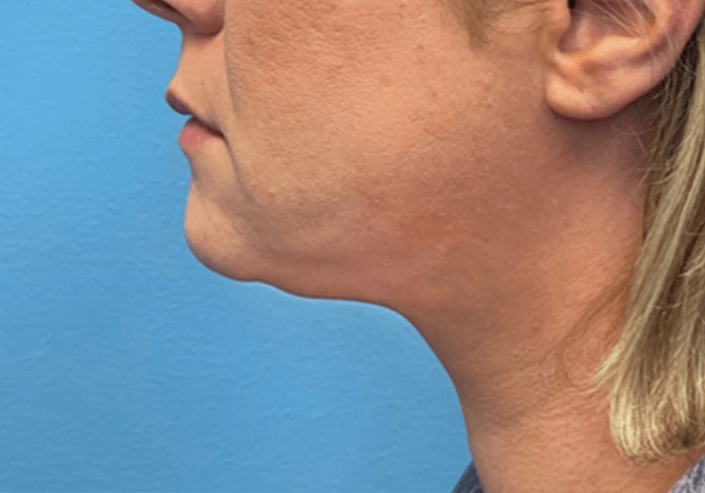 Submental-Liposuction-Case--20811 | After Submental Liposuction 1