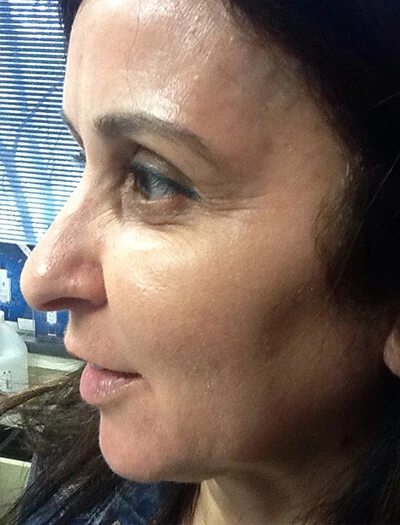 Chemical-Peel-Case--36 | After Non-Surgical 2