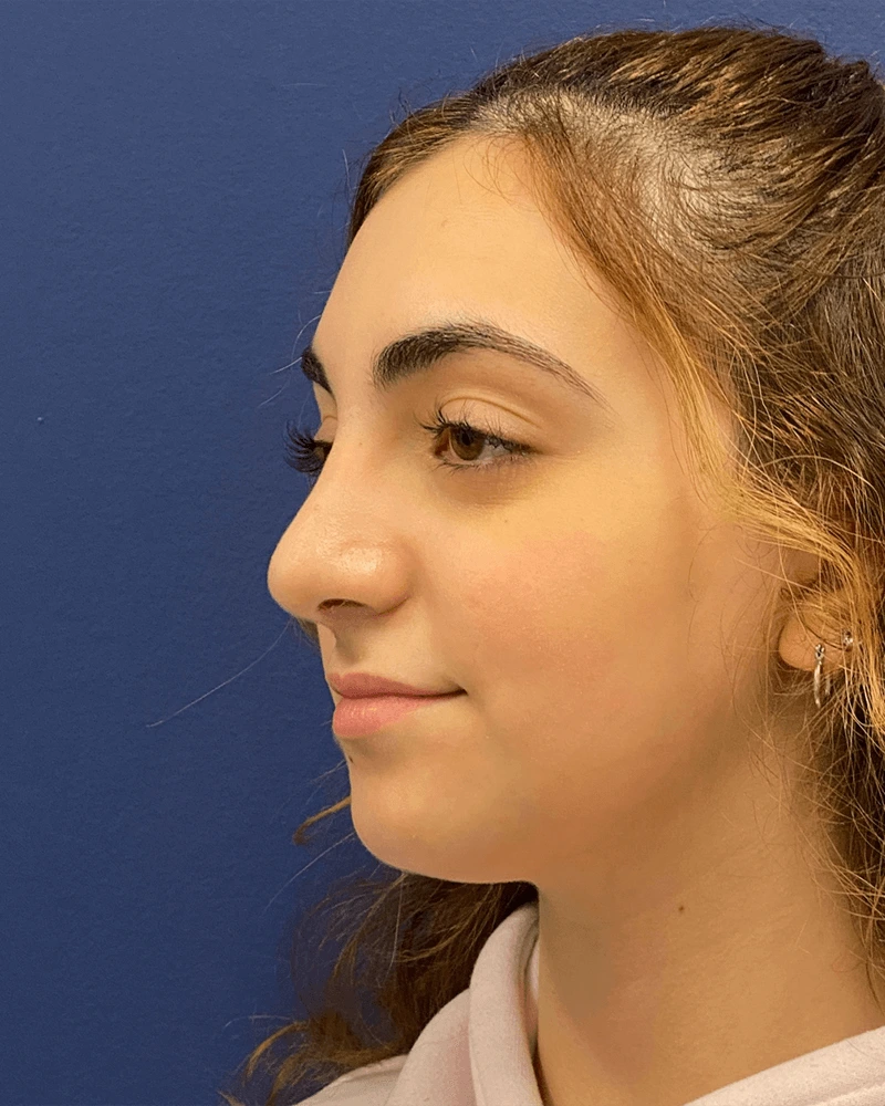 Rhinoplasty-Case--23921 | After Rhinoplasty 2