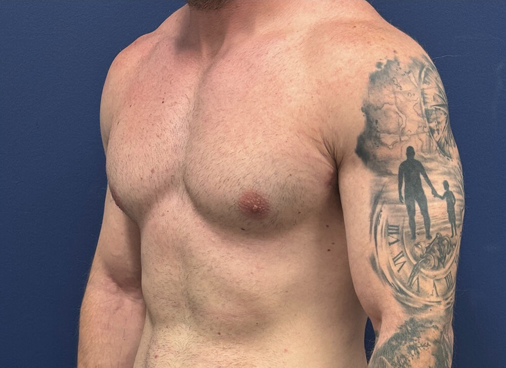 Gynecomastia-Case--28230 | After Breast 2