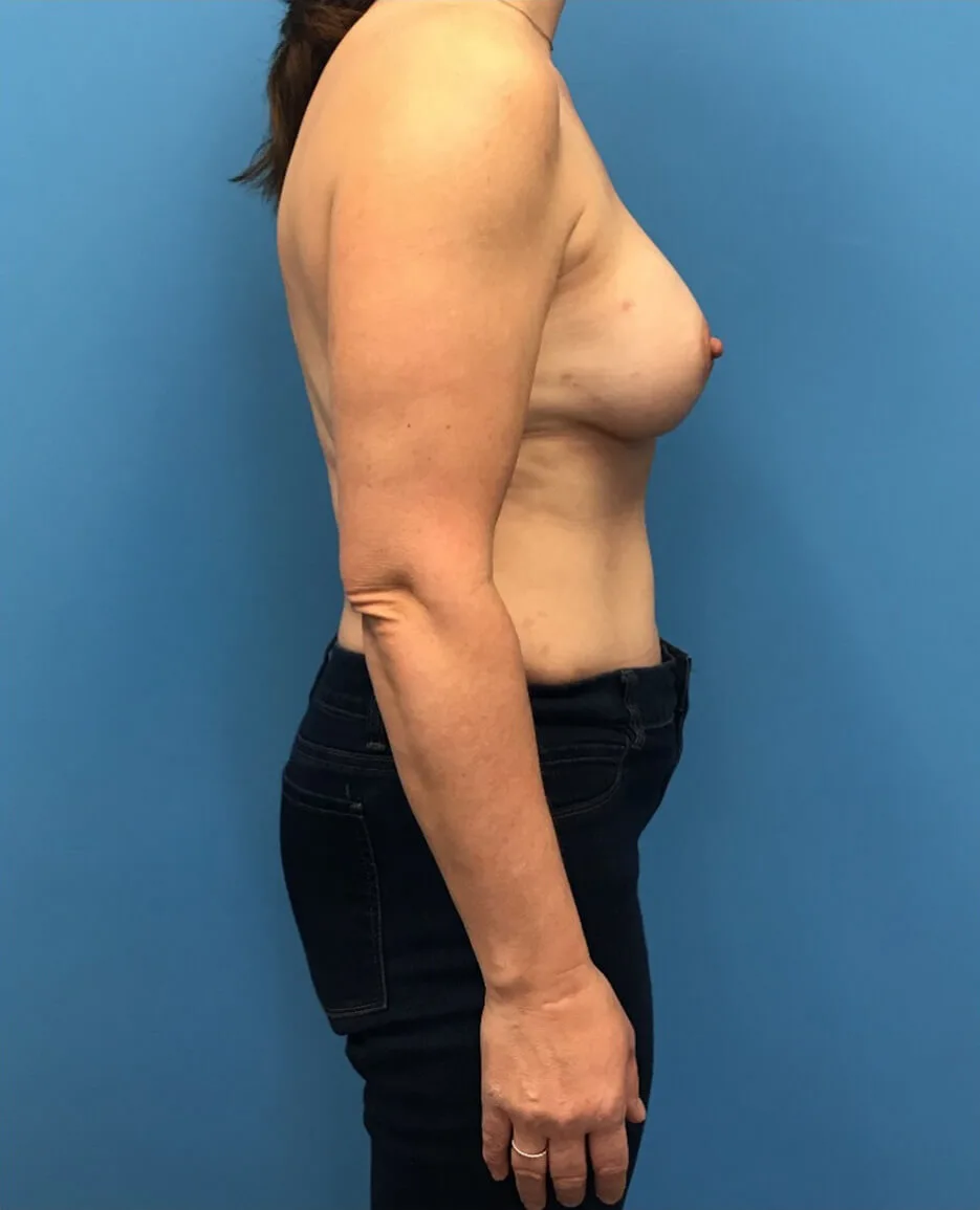 DIEP-Flap-Case--139 | After Breast 2