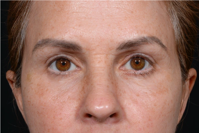 Quad-Blepheroplasty-Case--5361 | After Eyelid Surgery 1