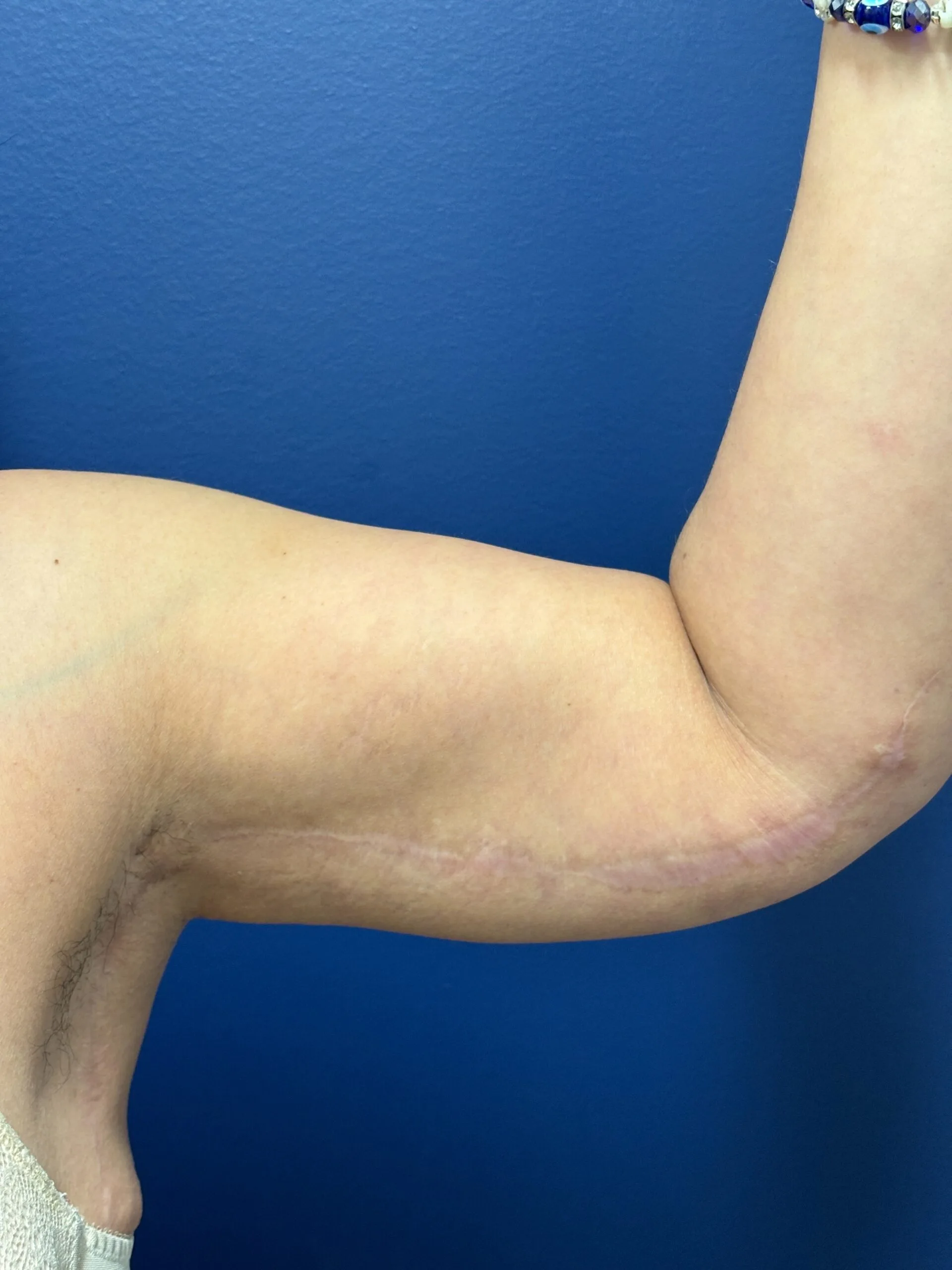Brachioplasty-Case--1162 | After Arm Lift 3