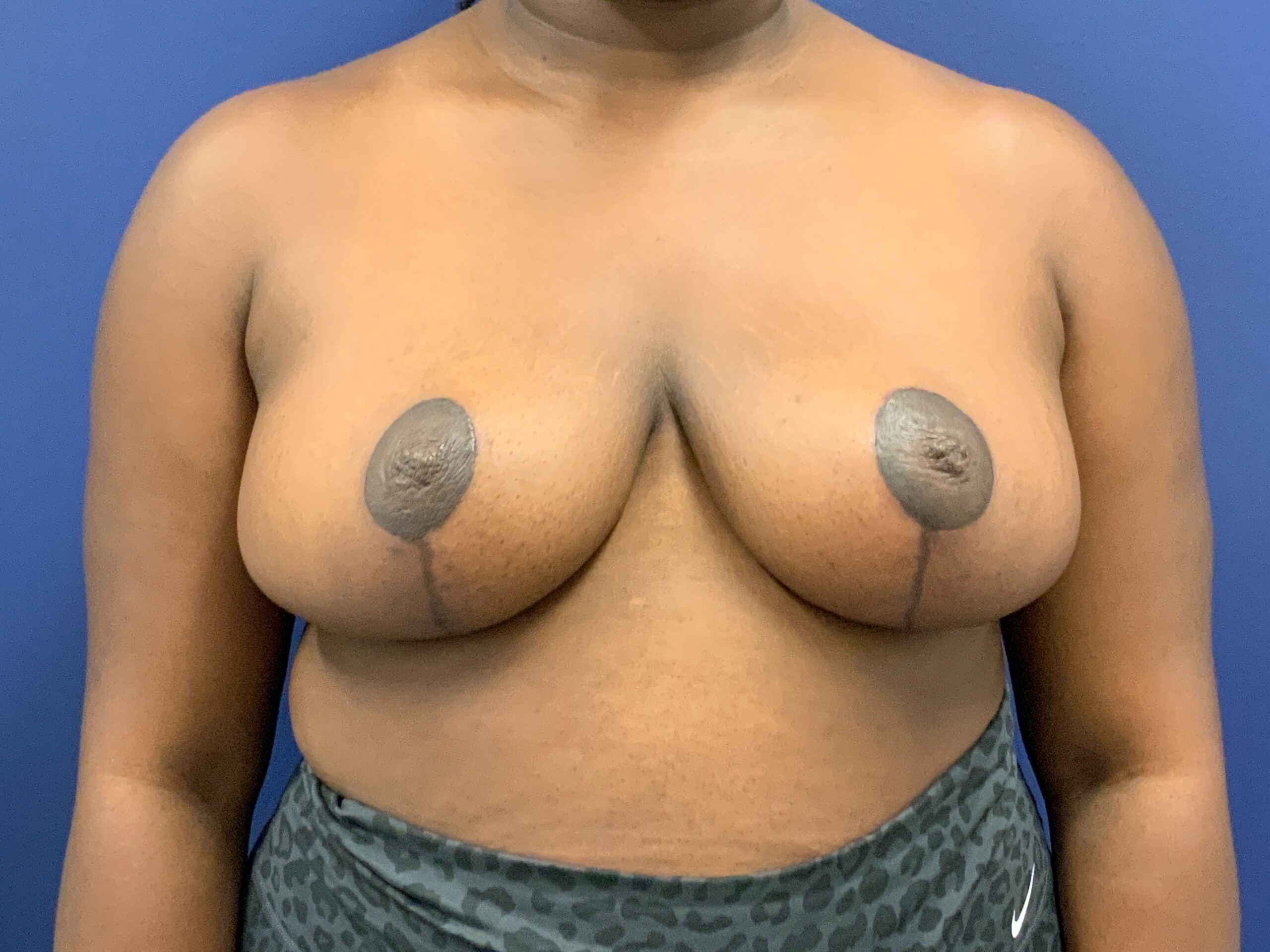 Breast-Reduction-Case--7783 | After Breast 1