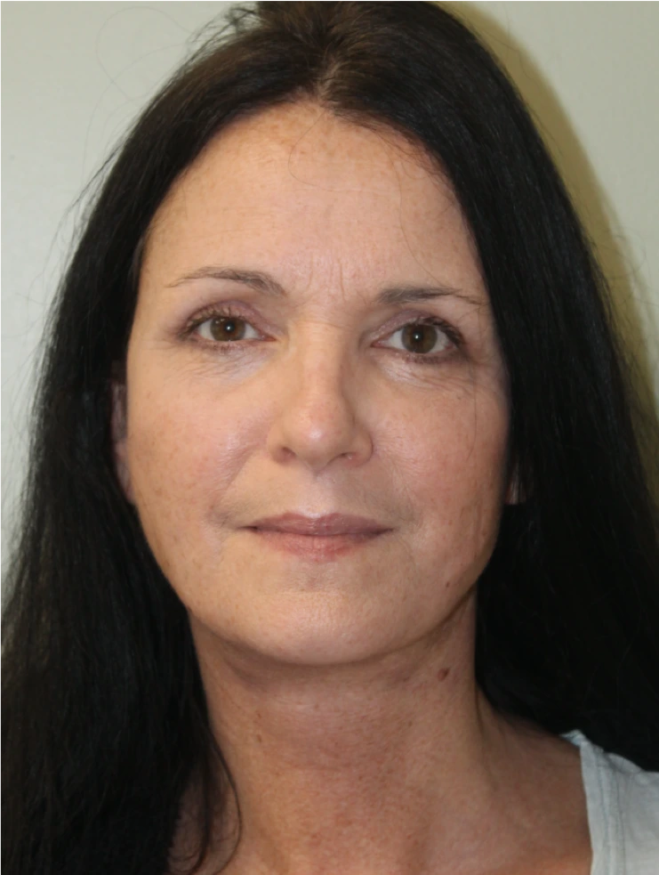 Face-and-Neck-Lift-Case--9403 | After Neck Lift 1