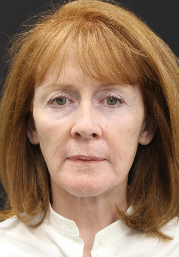 Face-and-Neck-Lift-Case--9302 | After Neck Lift 1