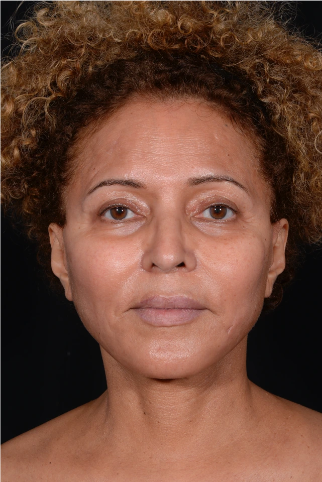Face-and-Neck-Lift-Case--3772 | After Neck Lift 1
