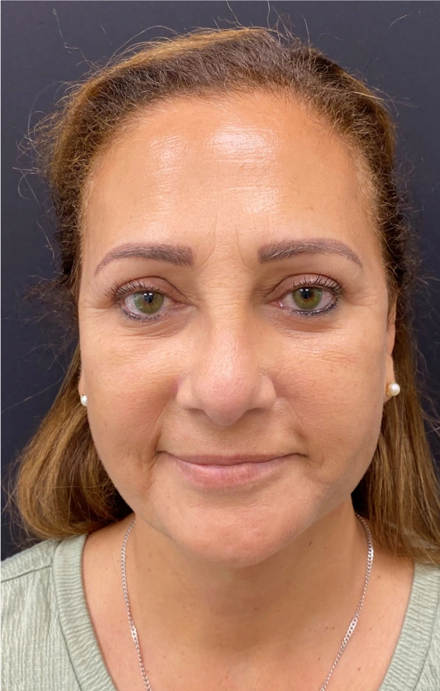 Rhinoplasty-Case--8713 | After Dr. Arjun Kanuri 1