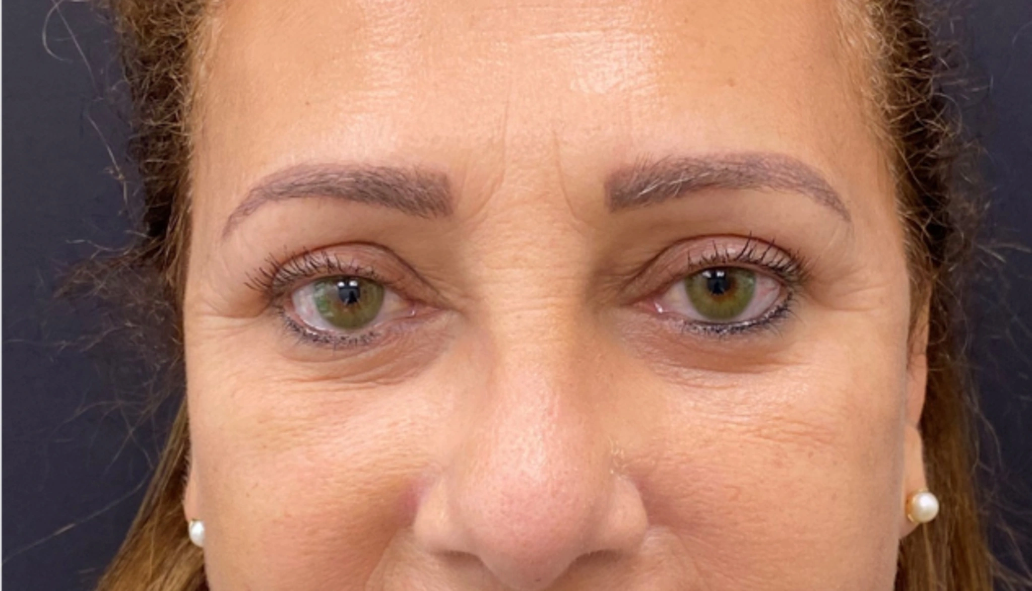 Brow-Lift-Case--6540 | After Brow Lift 1