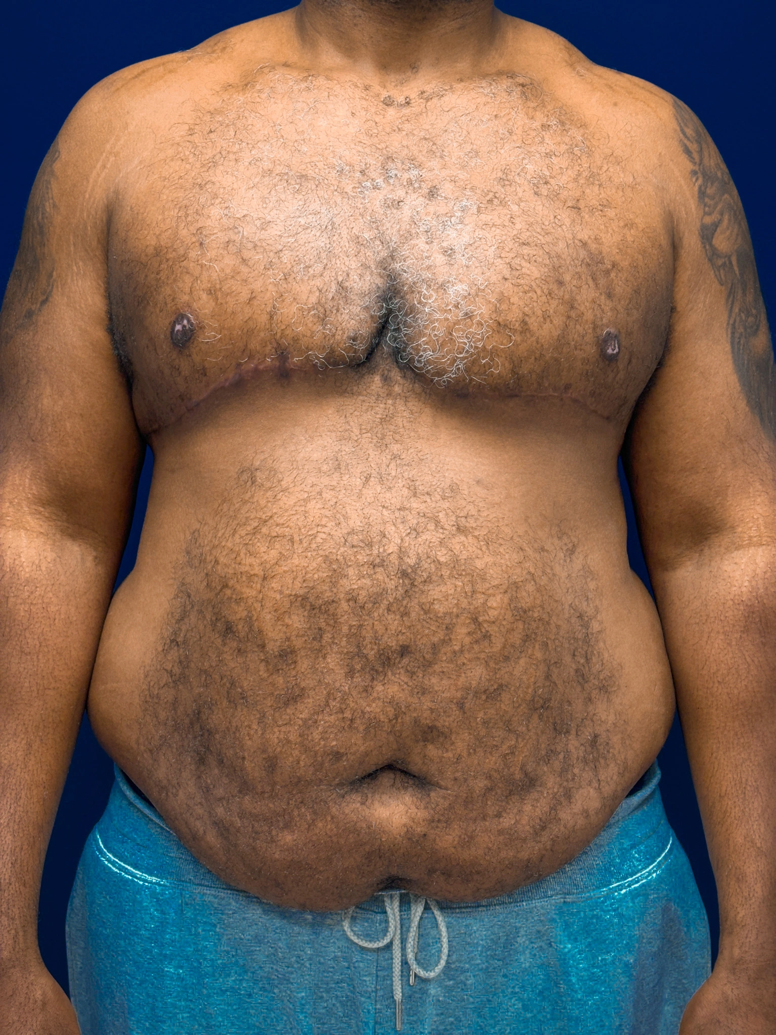 Gynecomastia-Case--4473 | After Breast 1