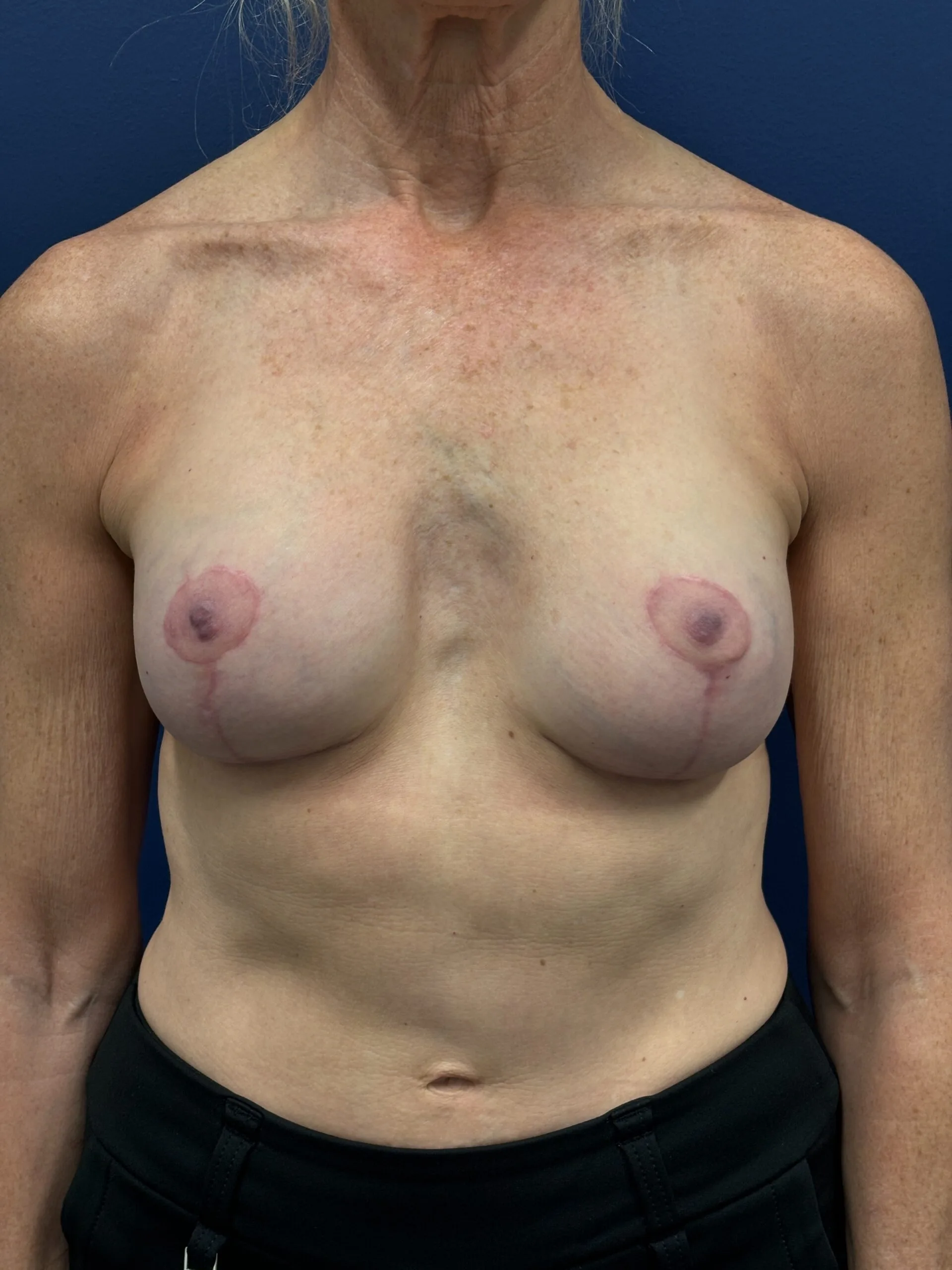 Augmentation-Mastopexy-Case--1505 | After Breast 1
