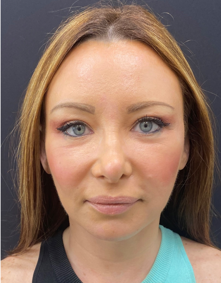Facelift-and-Facial-Fat-Grafting-Case--1679 | After Facelift 1