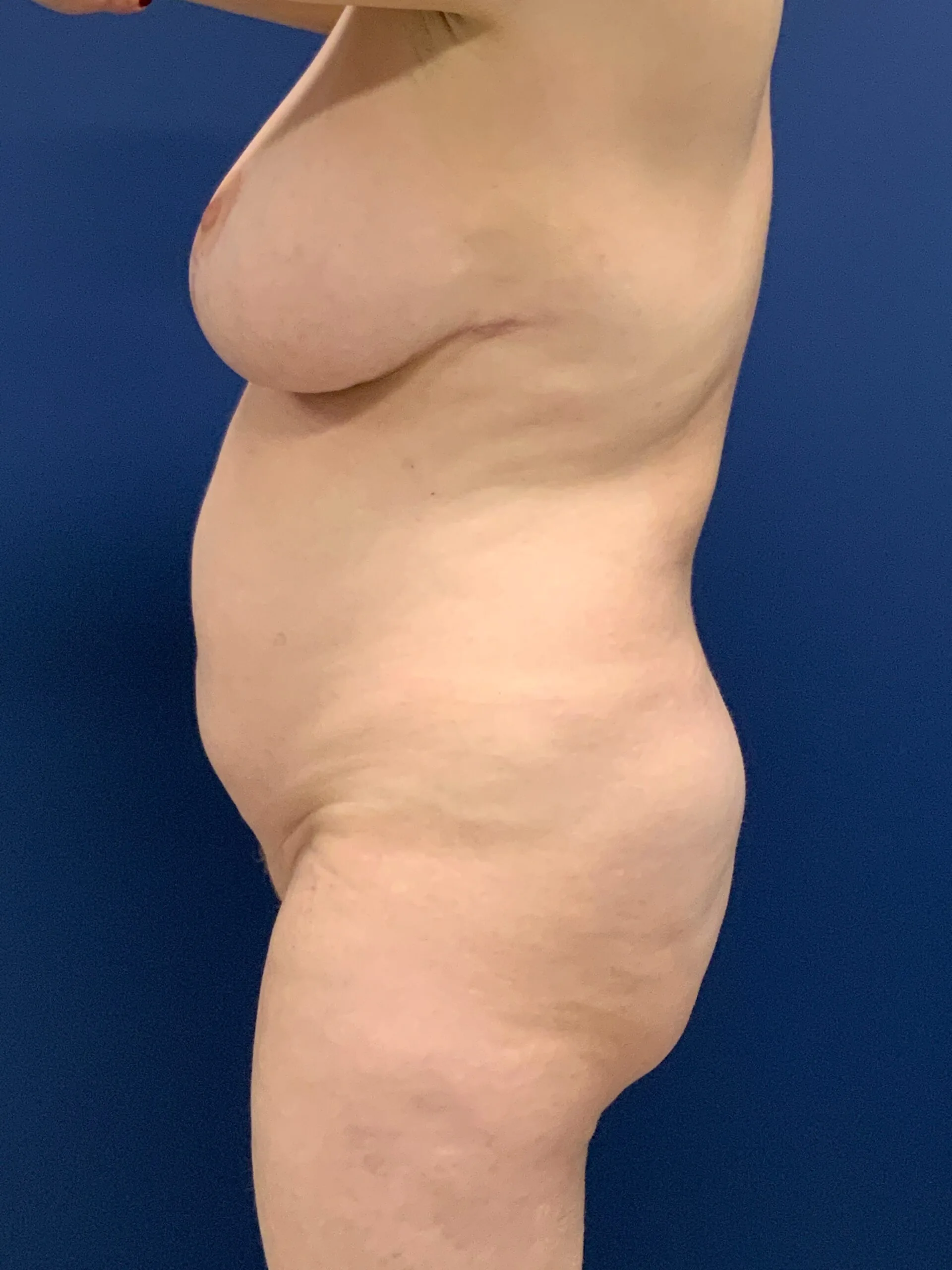 Breast-Reduction-Case--2878 | After Breast 2