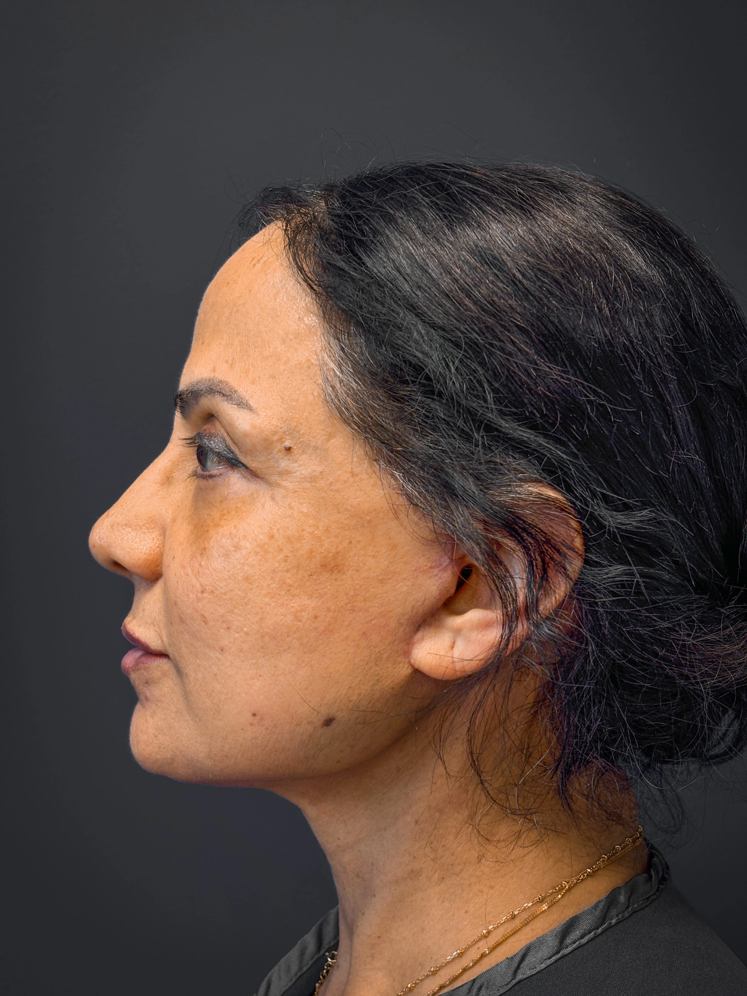 Facelift-and-Facial-Fat-Grafting-Case--8416 | After Facelift 3