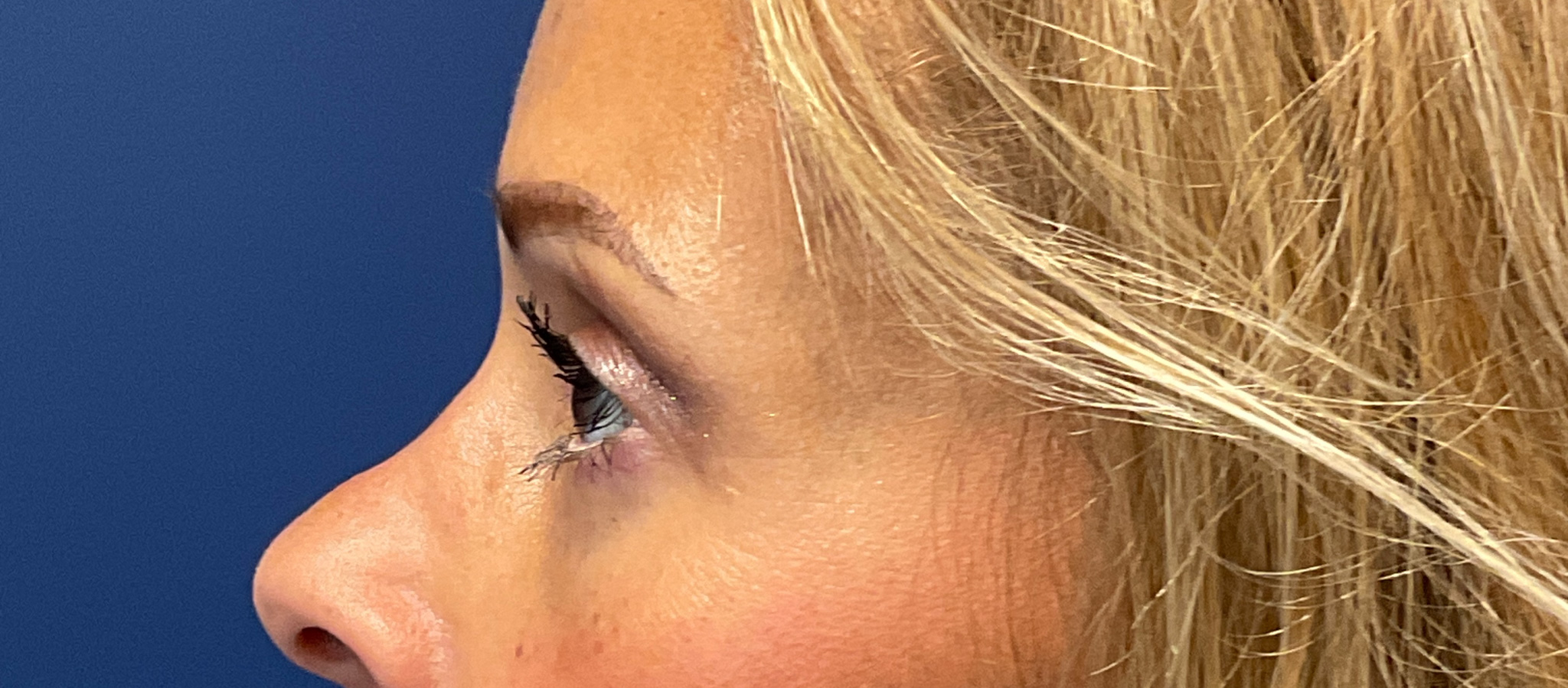 Quad-Blepharoplasty-Case--1261 | After Eyelid Surgery 3