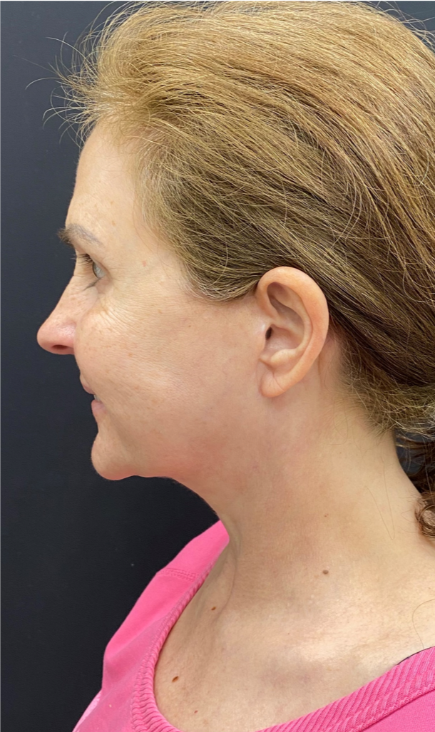 Necklift-Case--4836 | After Neck Lift 2