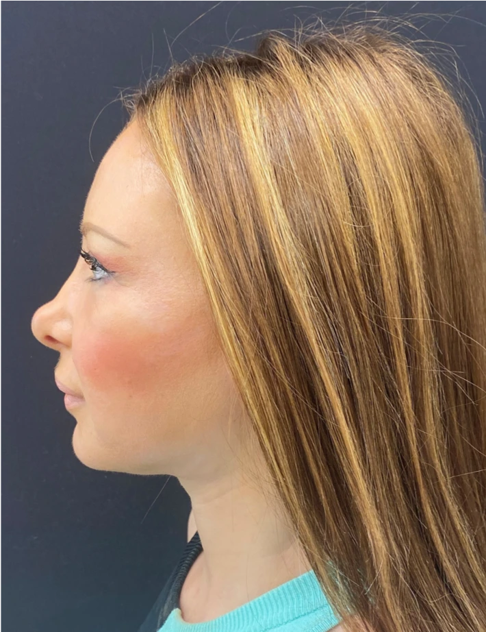 Facelift-and-Facial-Fat-Grafting-Case--1679 | After Facelift 2