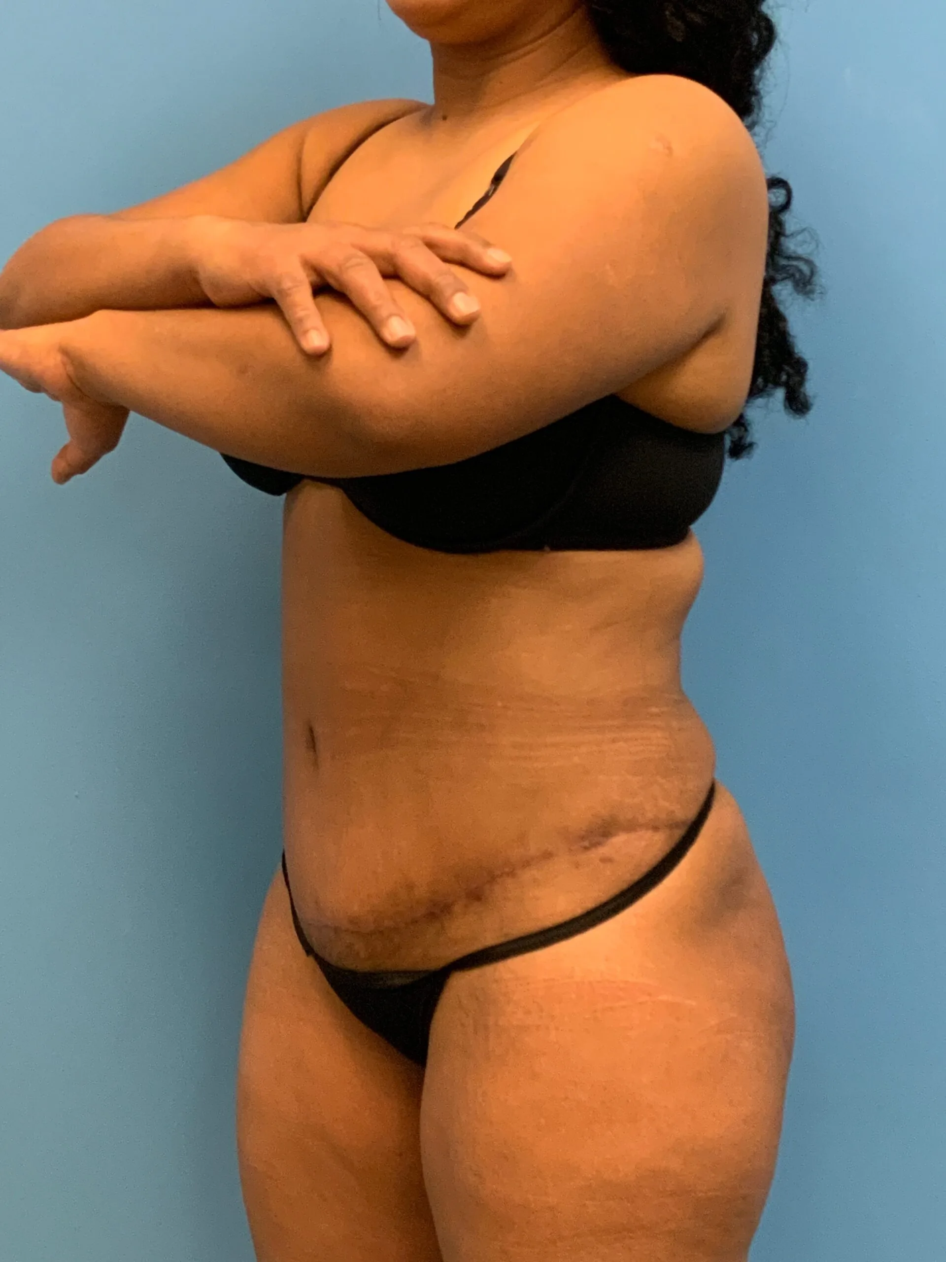 Abdominoplasty-Case--1110 | After Tummy Tuck 5