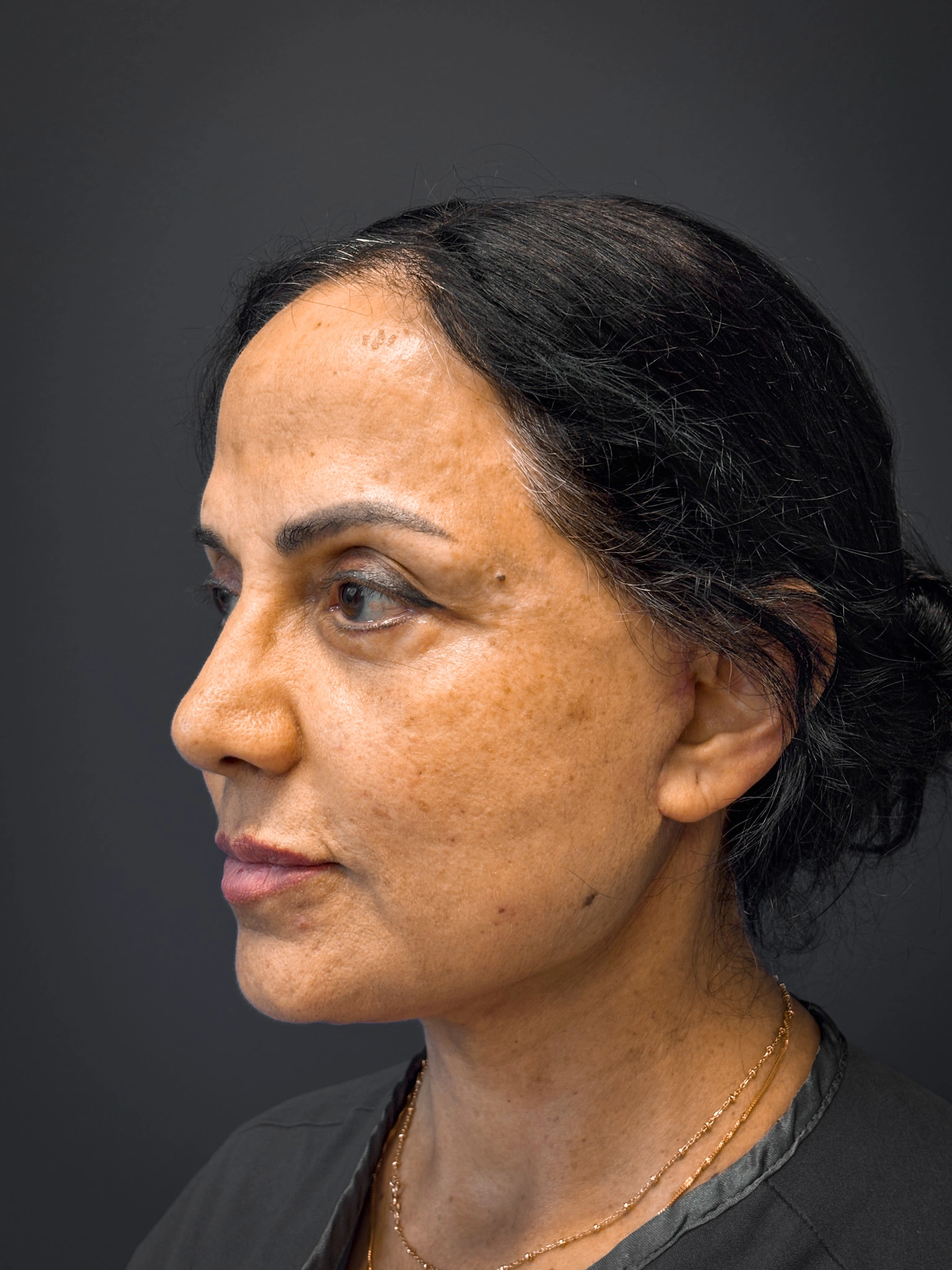 Facelift-and-Facial-Fat-Grafting-Case--8416 | After Facelift 5