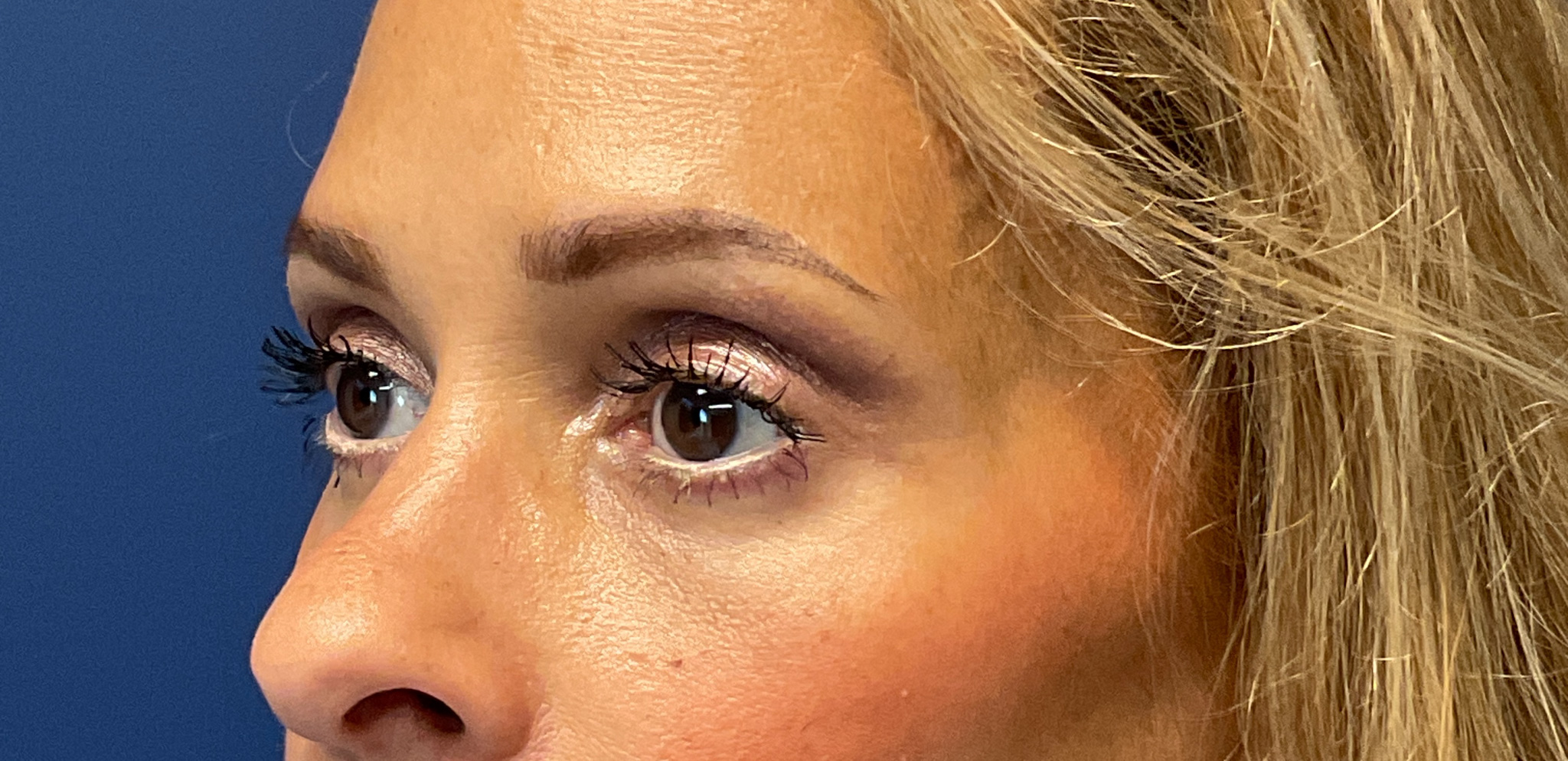 Quad-Blepharoplasty-Case--1261 | After Eyelid Surgery 5