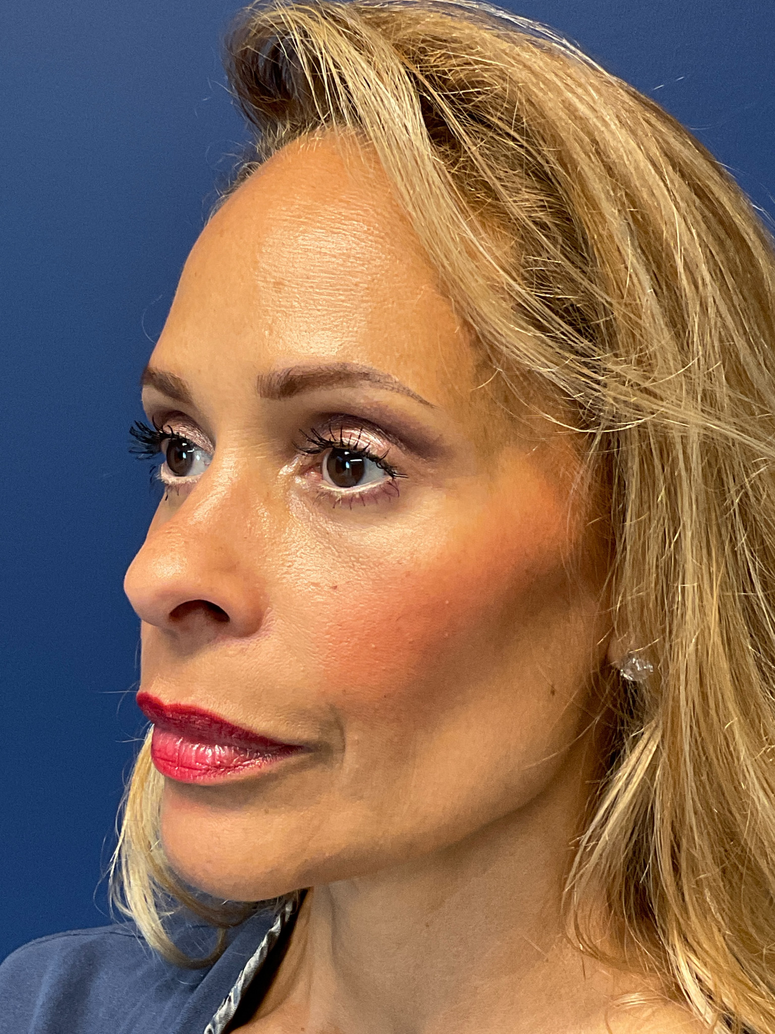 Facelift-and-Facial-Fat-Grafting-Case--4152 | After Facelift 5