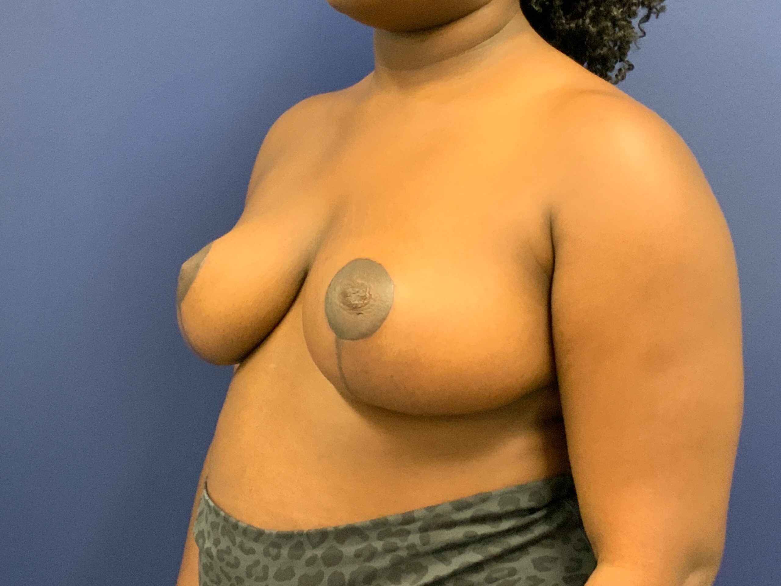 Breast-Reduction-Case--7783 | After Breast Reduction 5