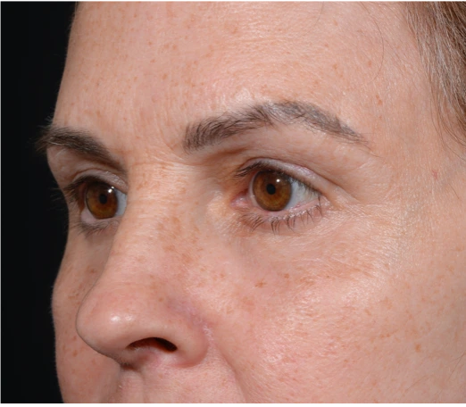 Quad-Blepheroplasty-Case--5361 | After Eyelid Surgery 3