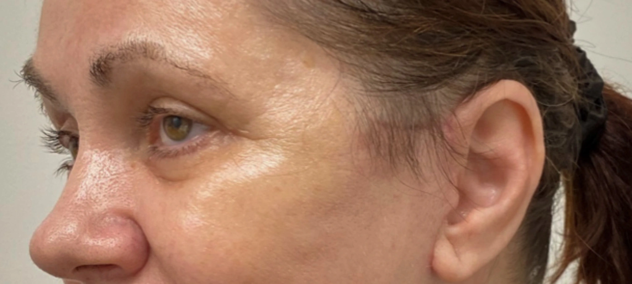 Quad-Blepharoplasty-Case--1851 | After Eyelid Surgery 4