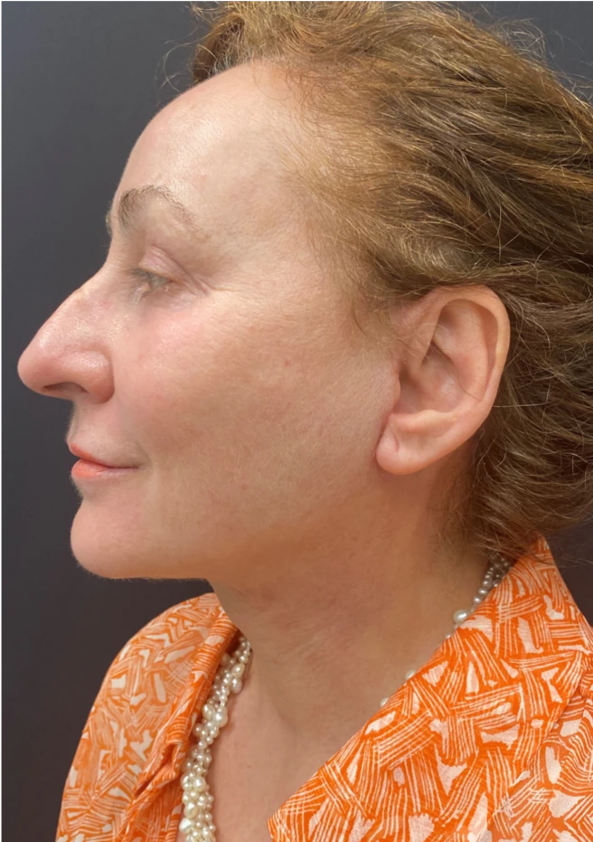 Face-and-Neck-Lift-Case--8423 | After Facelift 3