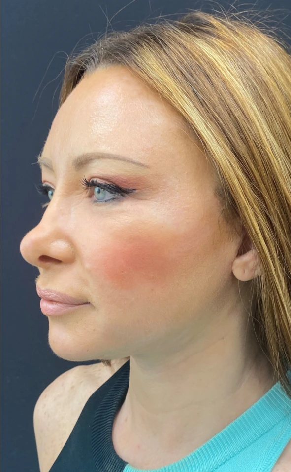 Facelift-and-Facial-Fat-Grafting-Case--1679 | After Facelift 3