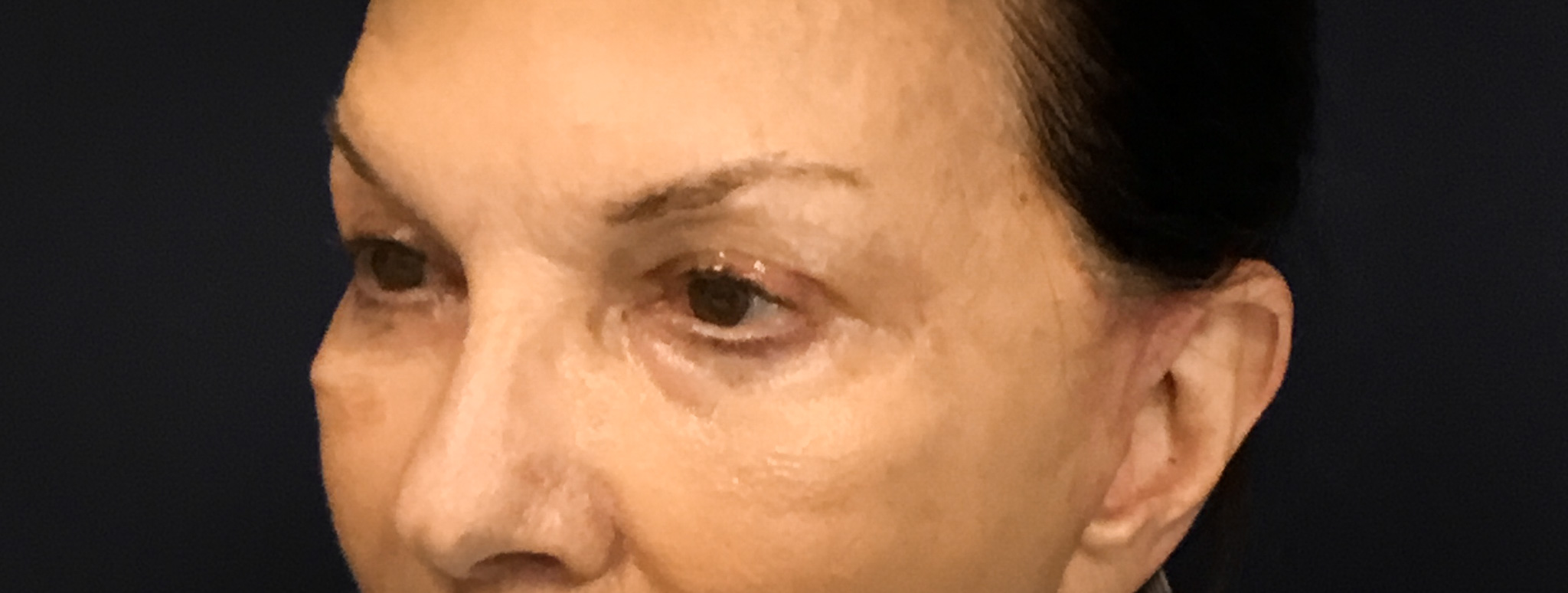 Upper-Blepharoplasty-Case--2075 | After Eyelid Surgery 3