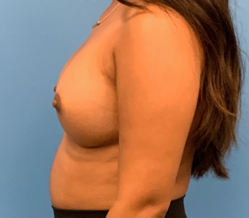 Breast-Augmentation-Case--1115 | After Breast 2