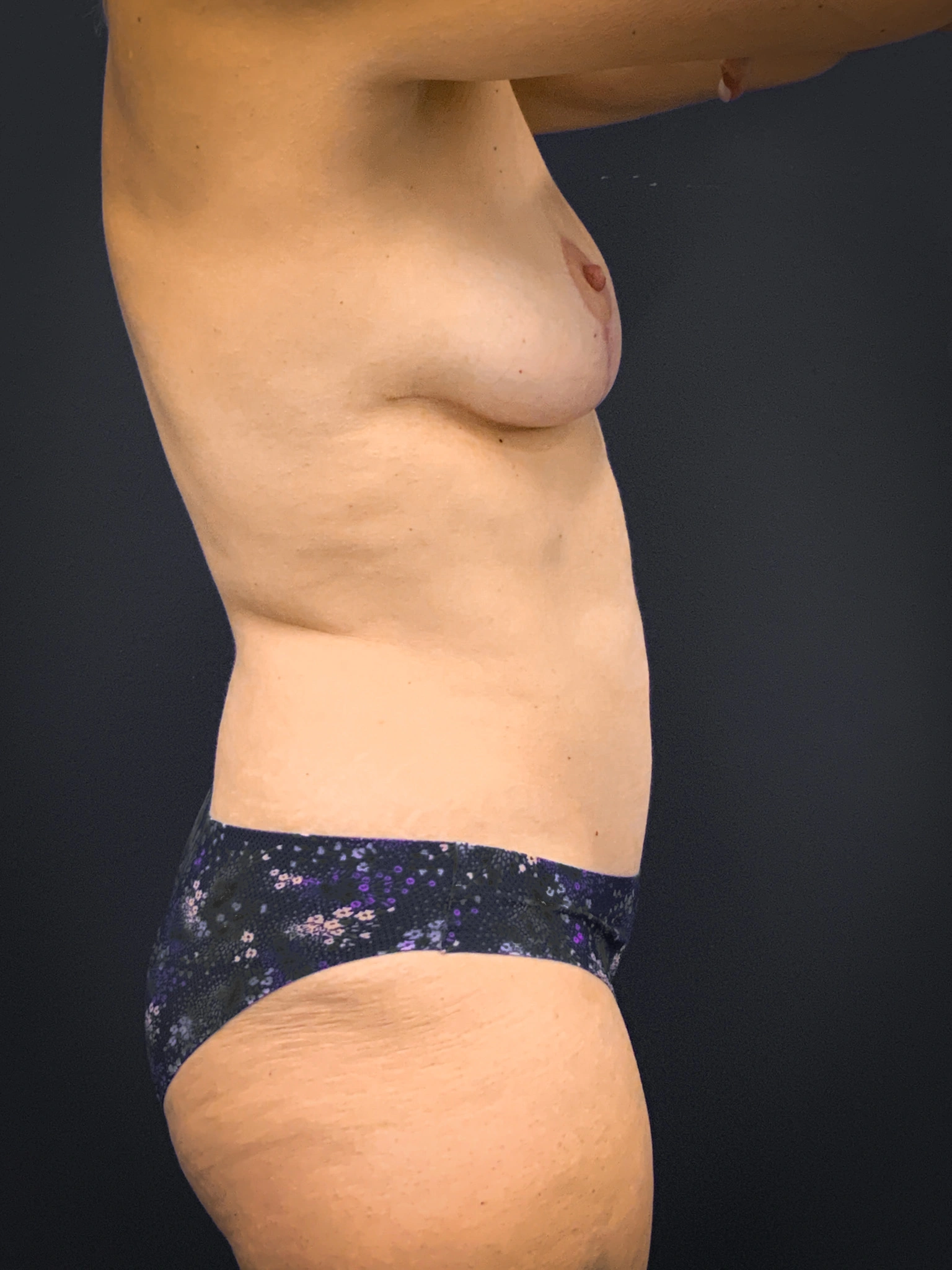 Breast-Augmentation-Case--1469 | After Breast 2