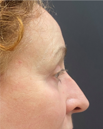 Blepharoplasty-Case--9685 | After Eyelid Surgery 2