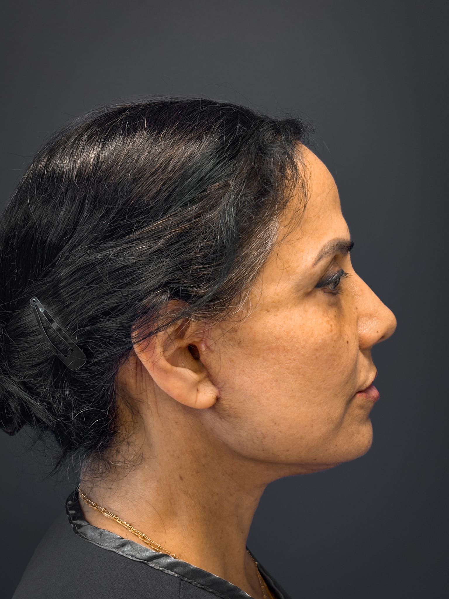 Facelift-and-Facial-Fat-Grafting-Case--8416 | After Facelift 2