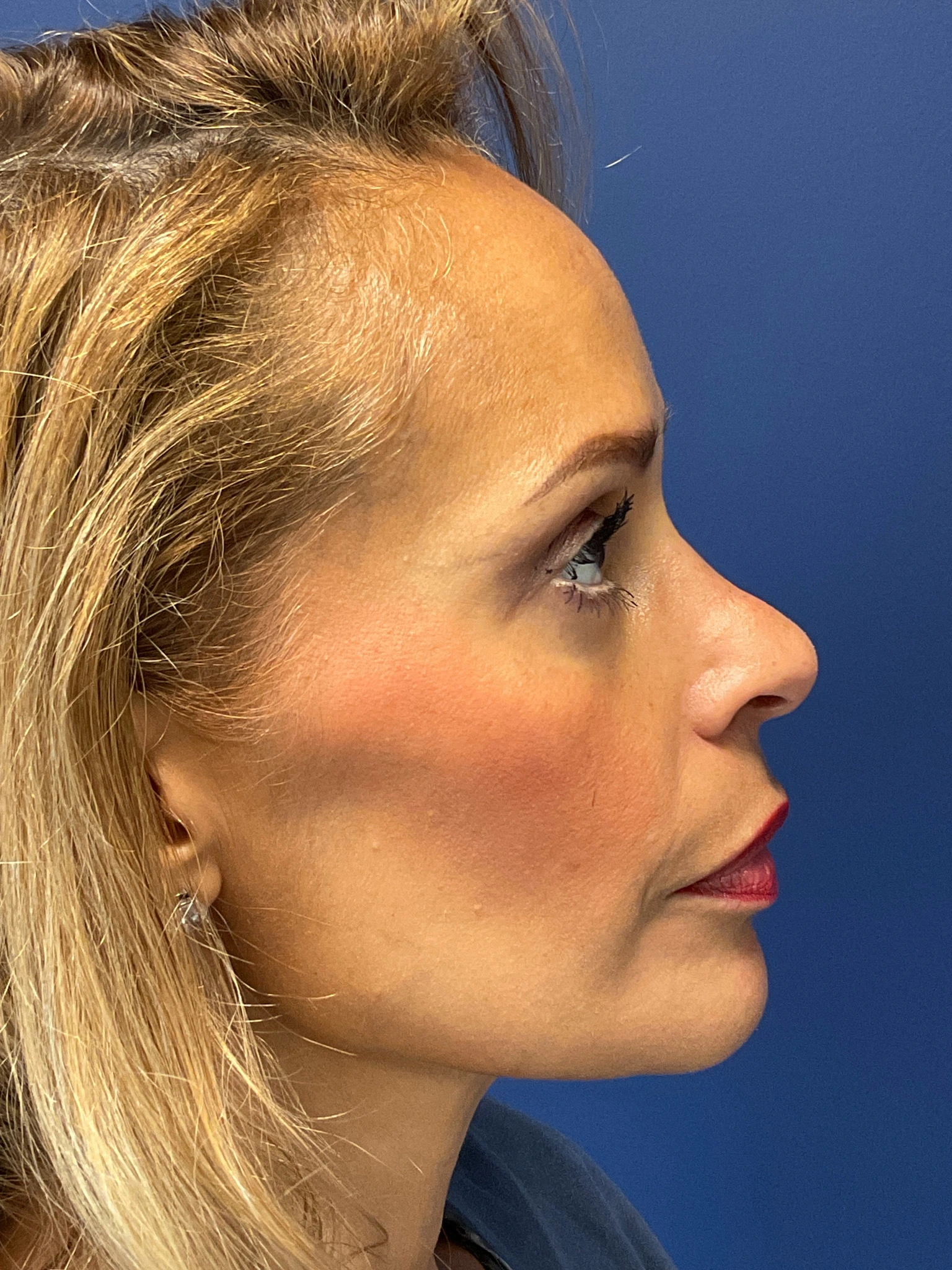 Facelift-and-Facial-Fat-Grafting-Case--4152 | After Facelift 2