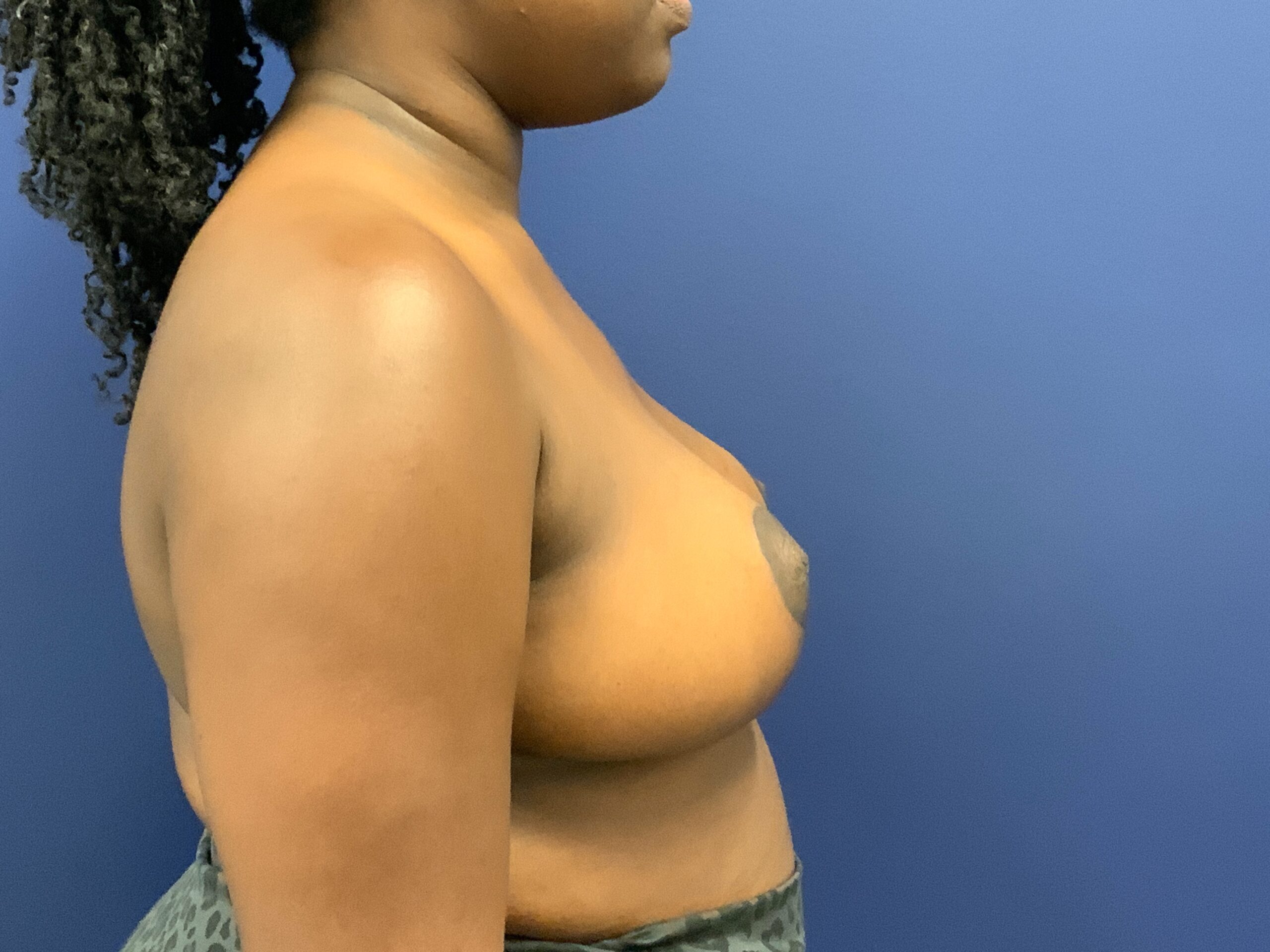 Breast-Reduction-Case--7783 | After Breast 2