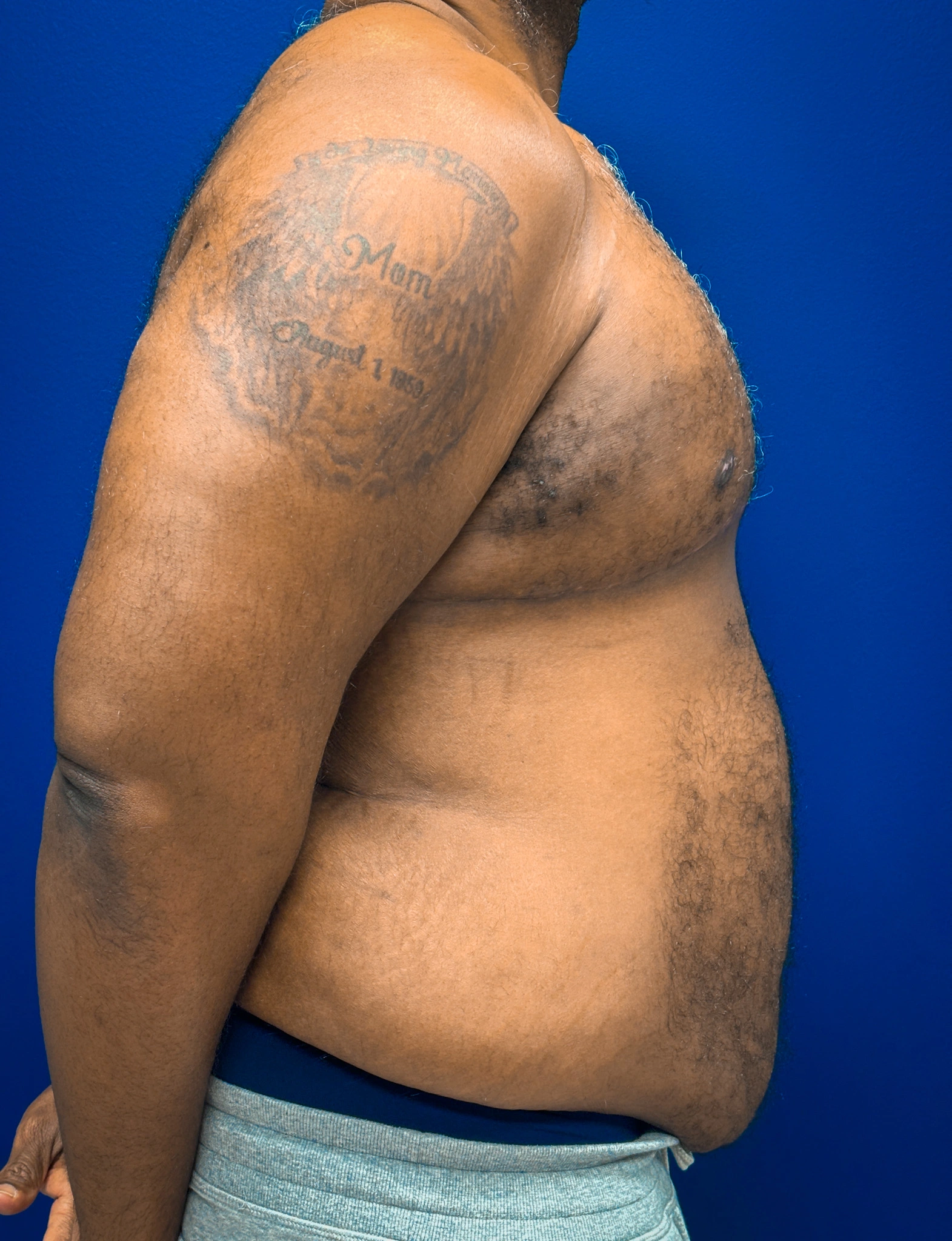 Gynecomastia-Case--4473 | After Breast 2
