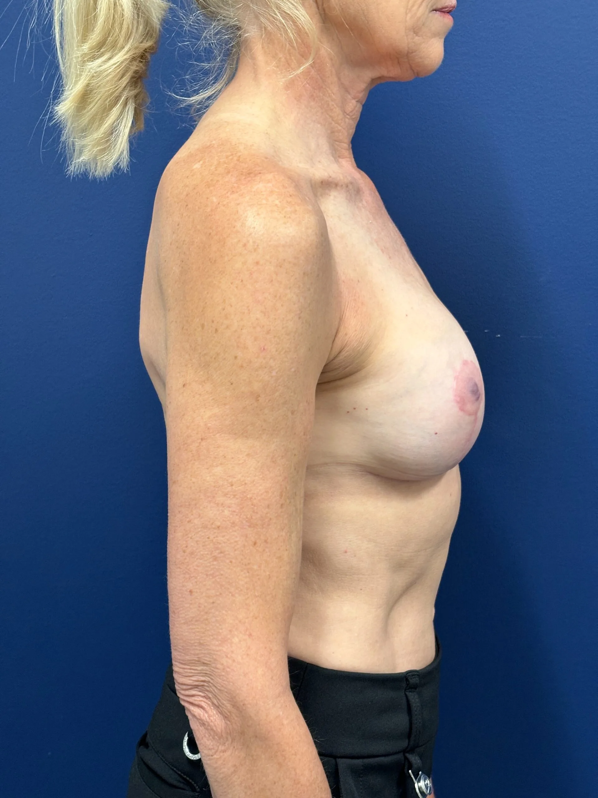 Augmentation-Mastopexy-Case--1505 | After Breast 2