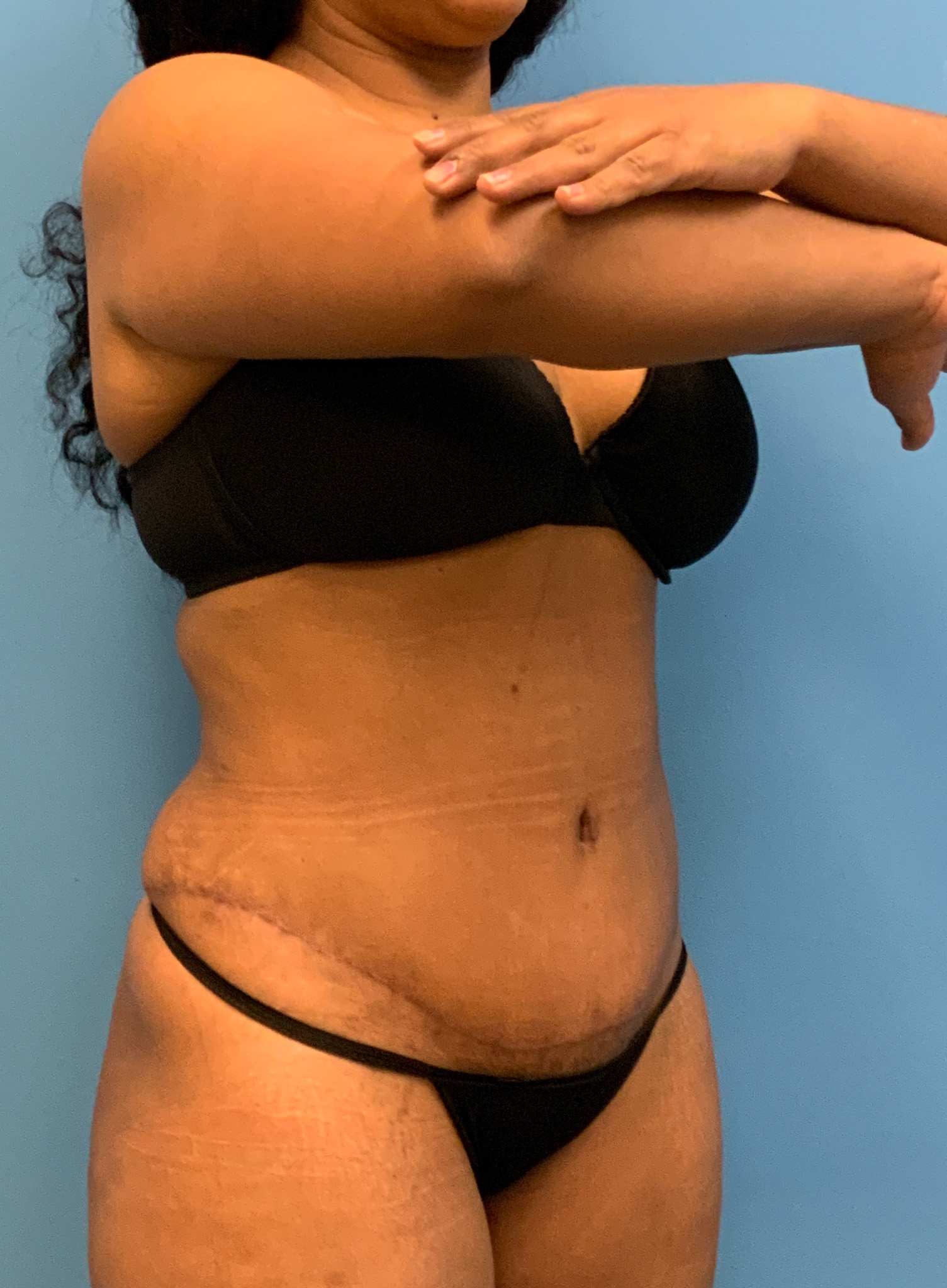 Abdominoplasty-Case--1110 | After Tummy Tuck 4