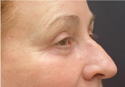 Blepharoplasty-Case--9685 | After Eyelid Surgery 3