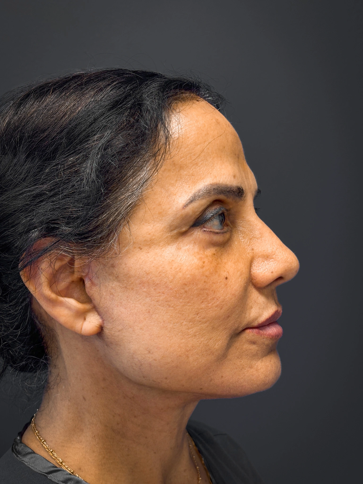 Facelift-and-Facial-Fat-Grafting-Case--8416 | After Facelift 4