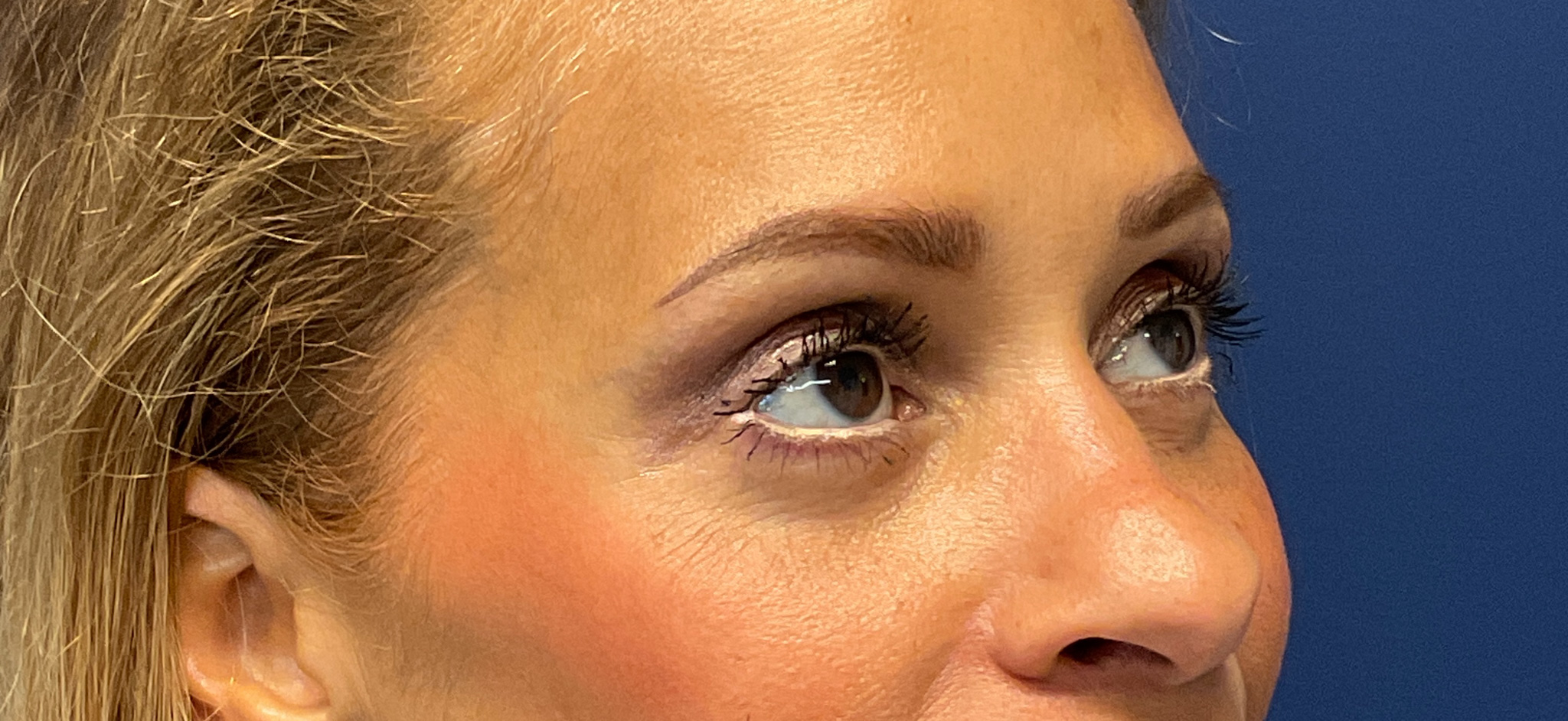 Quad-Blepharoplasty-Case--1261 | After Eyelid Surgery 4