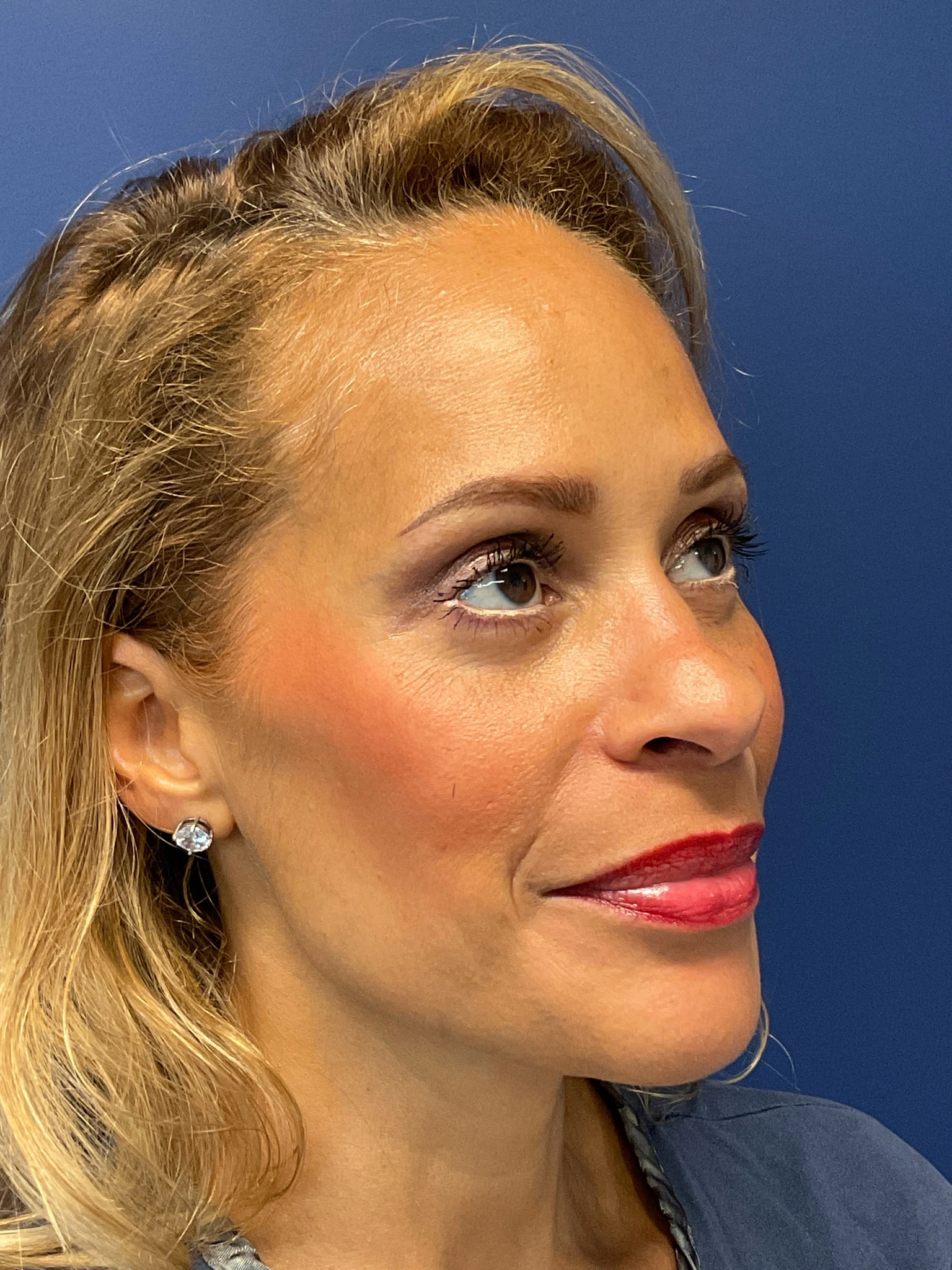 Facelift-and-Facial-Fat-Grafting-Case--4152 | After Facelift 4