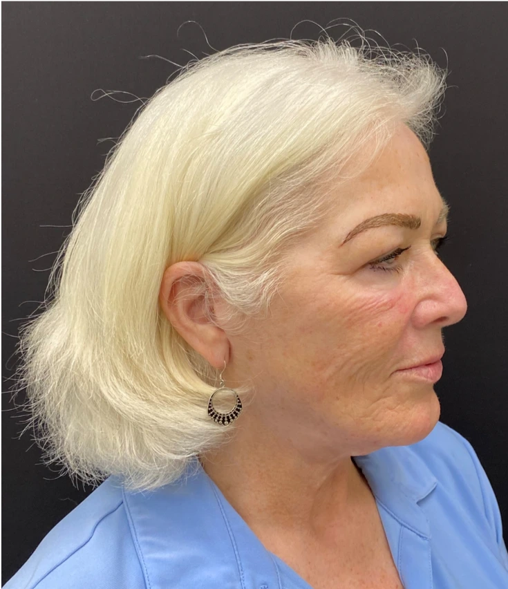 Face-and-Neck-Case--1975 | After Neck Lift 2