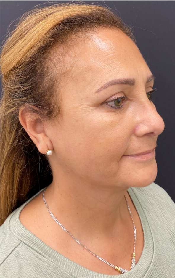 Necklift-Case--4869 | After Neck Lift 3