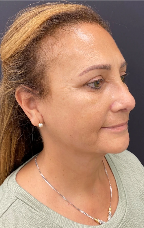 Rhinoplasty-Case--8713 | After Rhinoplasty 3